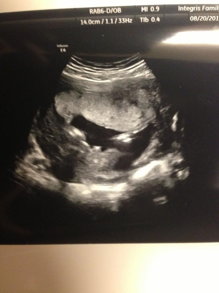 Update on conflicting MaterniT21 gender results BabyCenter